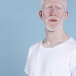 homem_albino.jpg