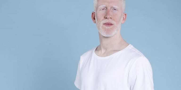 homem_albino.jpg