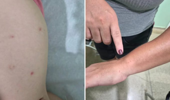 Coceiras, manchas na pele: o que indicam os sintomas apresentados por adultos e crianças em Brodowski, SP