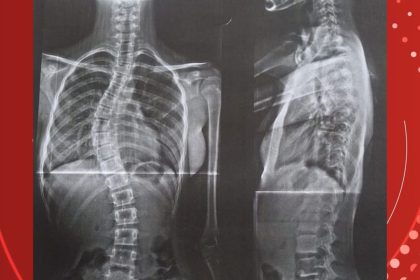 Após enfrentar o governo, mãe consegue cirurgia para filha com coluna em formato de ‘S’ em RO