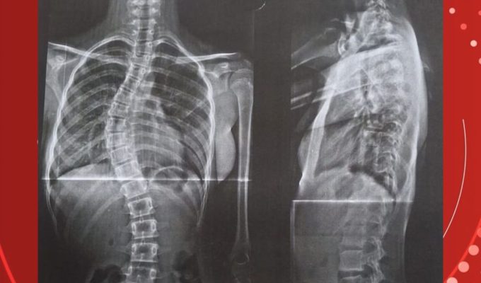 Após enfrentar o governo, mãe consegue cirurgia para filha com coluna em formato de ‘S’ em RO
