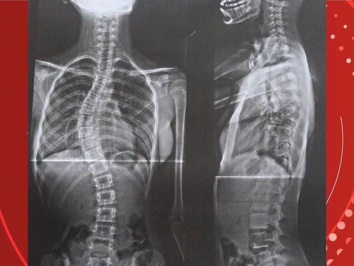 Após enfrentar o governo, mãe consegue cirurgia para filha com coluna em formato de ‘S’ em RO