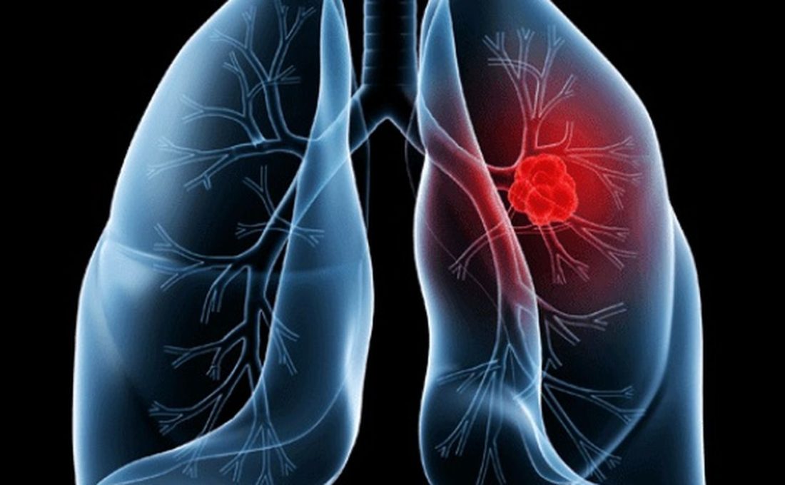 Saiba o que é adenocarcinoma pulmonar, câncer que atinge o Papa Leão