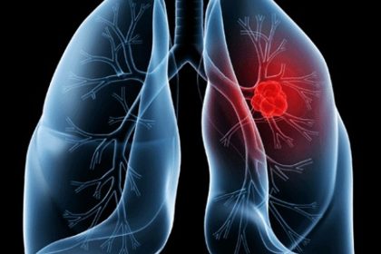 Saiba o que é adenocarcinoma pulmonar, câncer que atinge o Papa Leão