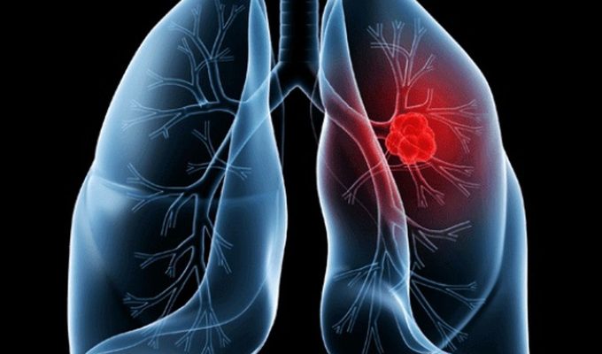 Saiba o que é adenocarcinoma pulmonar, câncer que atinge o Papa Leão