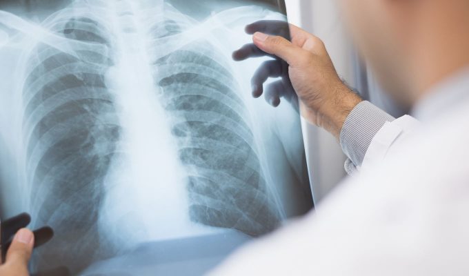 Anvisa aprova novo medicamento para câncer de pulmão avançado